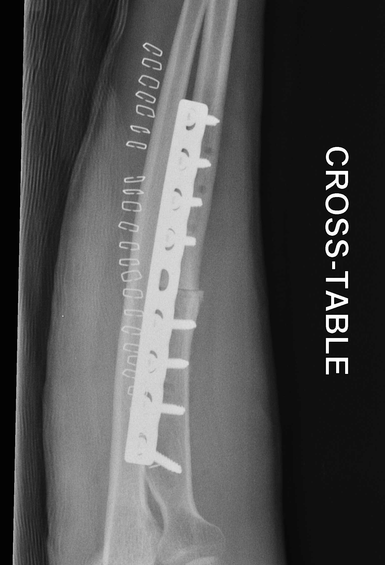 Radial Osteotomy 